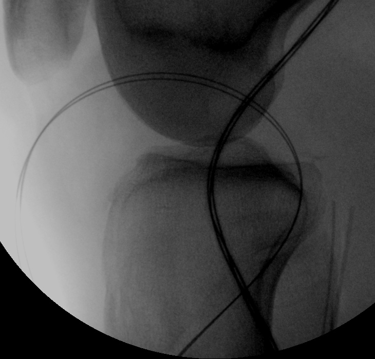 PCL Lars Tibial Wire Loop